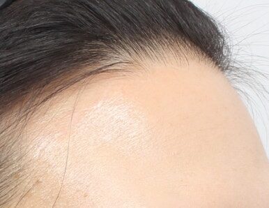 Will There Be Visible Scarring After Forehead Reduction?